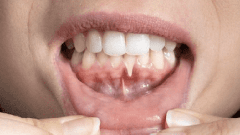 dental tissue grafting in mitchell sd