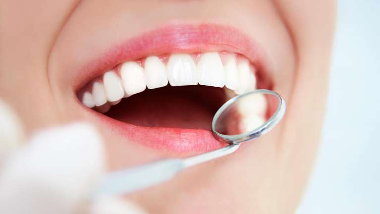 clean white teeth of woman after dental cleaning in Mitchell, SD