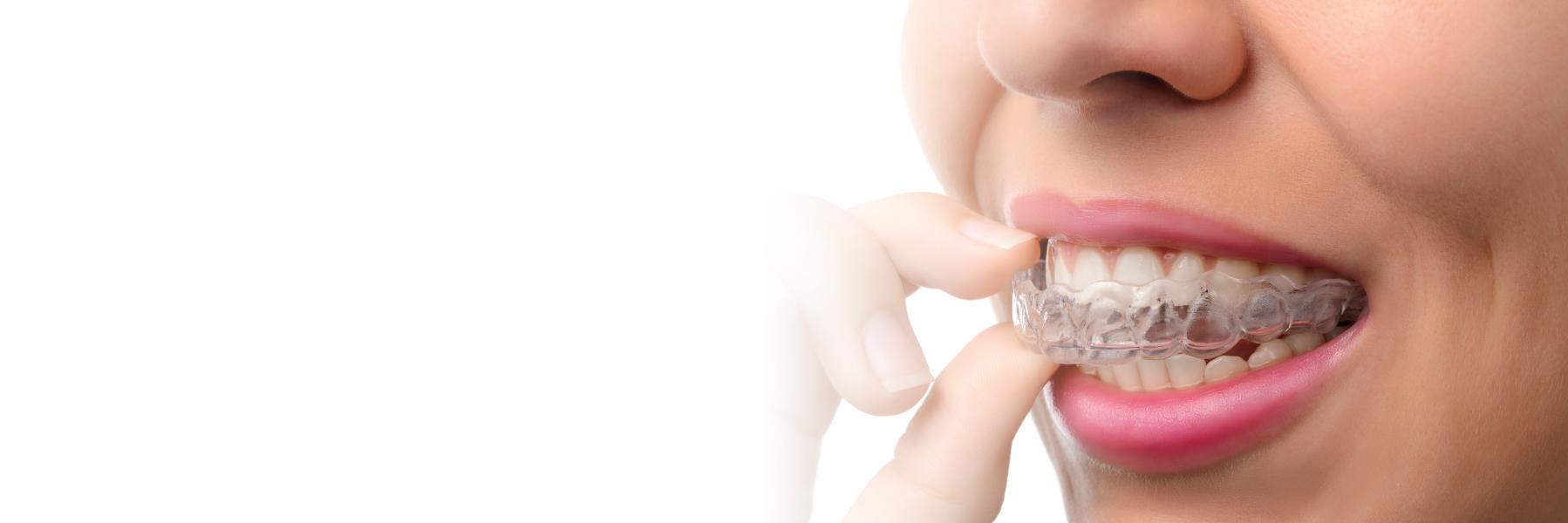 Woman putting on Invisalign clear braces in Mitchell, SD