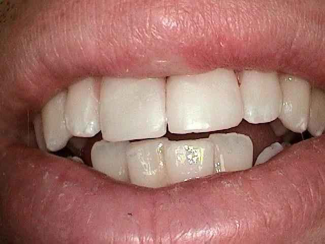 Results from chipped tooth repair in Mitchell