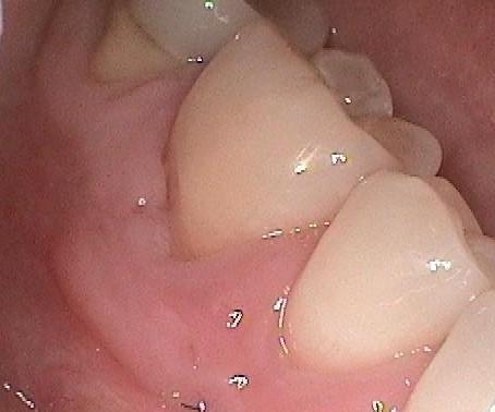 Results from gum graft procedure in Mitchell SD