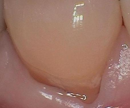 Close up of receding gums at dentist office in Mitchell