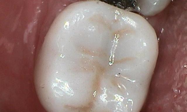 Results from tooth colored dental crown at Dental Health Partners