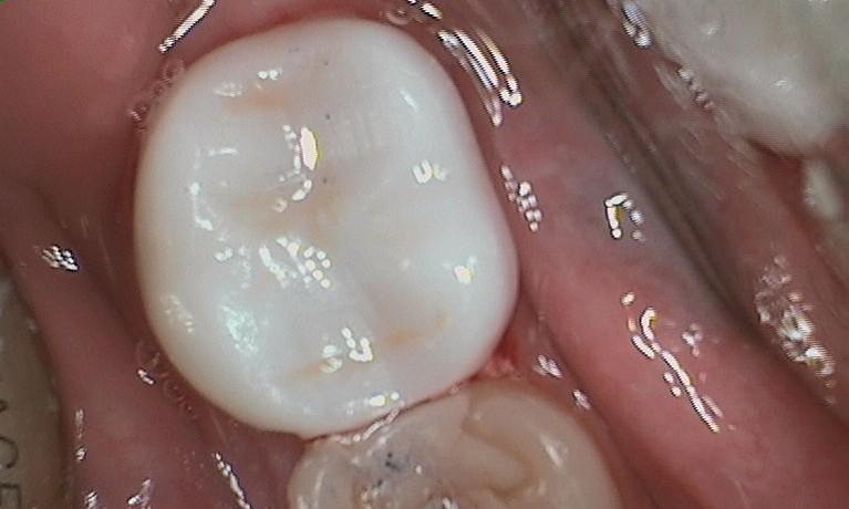 Results from dental crown placement in Mitchell SD