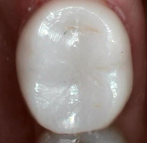 Close up of tooth colored dental crown in Mitchell SD