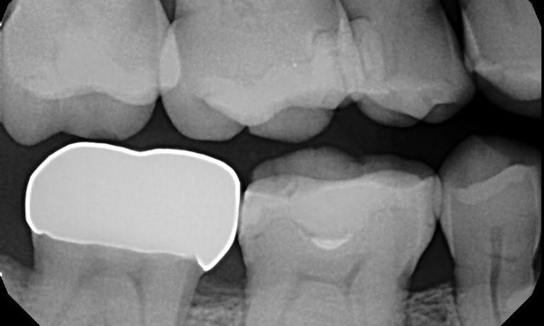 Digital X-Ray of dental crown placement in Mitchell SD
