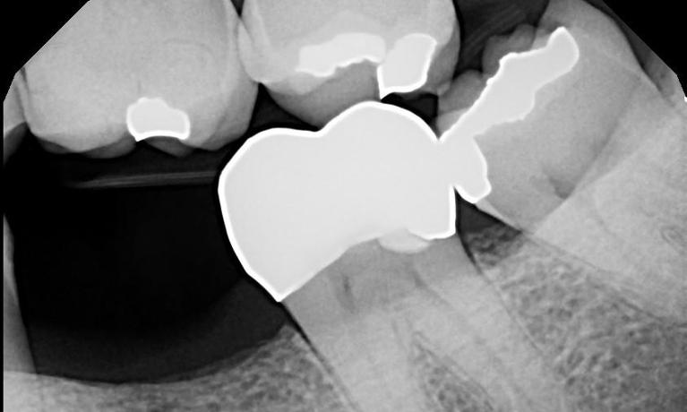 Digital X-ray of fully seated dental crown in Mitchell SD