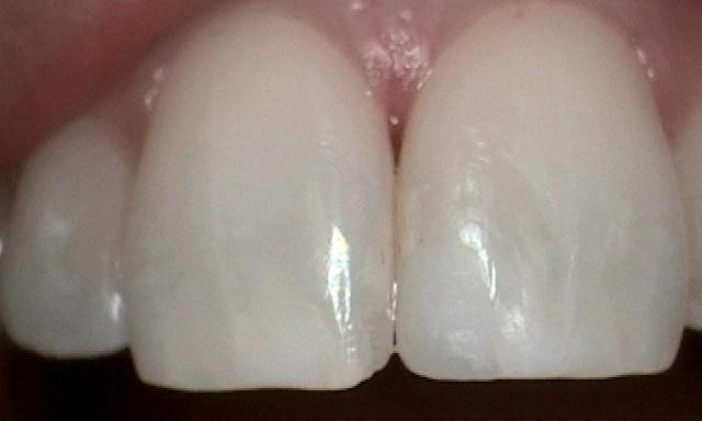 Results from chipped tooth repair with dental bonding in Mitchell SD