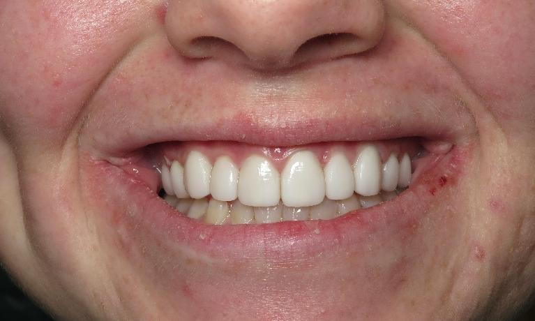 Veneers-to-Cover-Fluoride-Stained-Teeth-After-Image