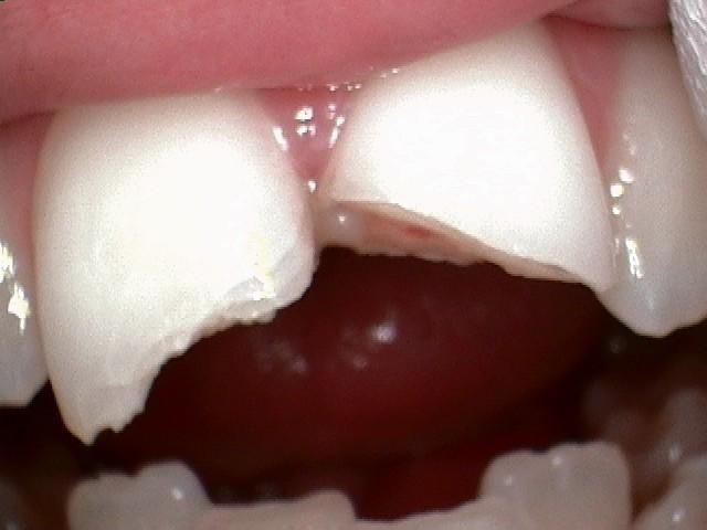 Close up of chipped front teeth at dentist in Mitchell