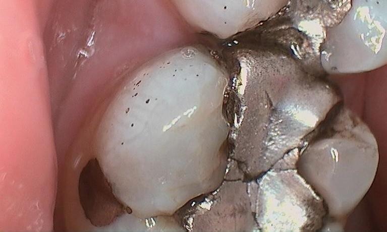 Close up of cracked metal filling at 57301 dentist office
