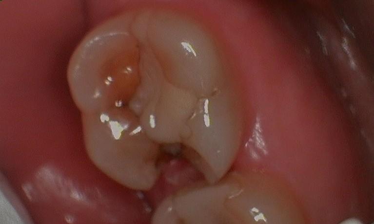 Molar with tooth decay and discoloration at 57301 dentist office