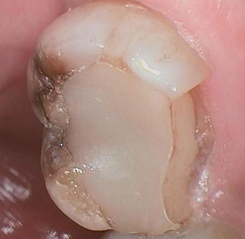 Close up of broken tooth at dentist office in Mitchell SD