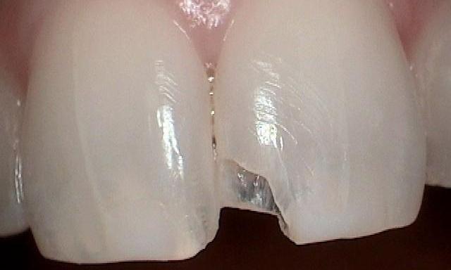 Close up of chipped front tooth at dentist office in Mitchell SD