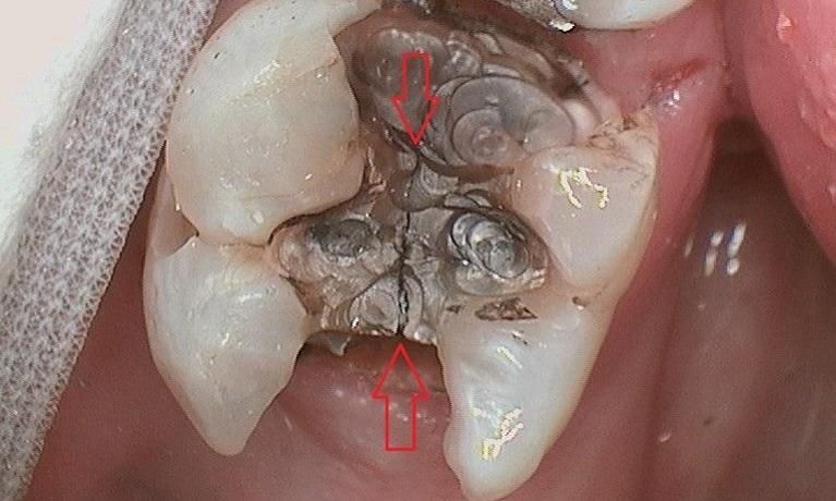 Close up of molar with metal dental filling removed at Dr Cody Gronsten DDS